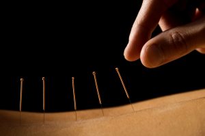 Acupuncture needles being inserted
